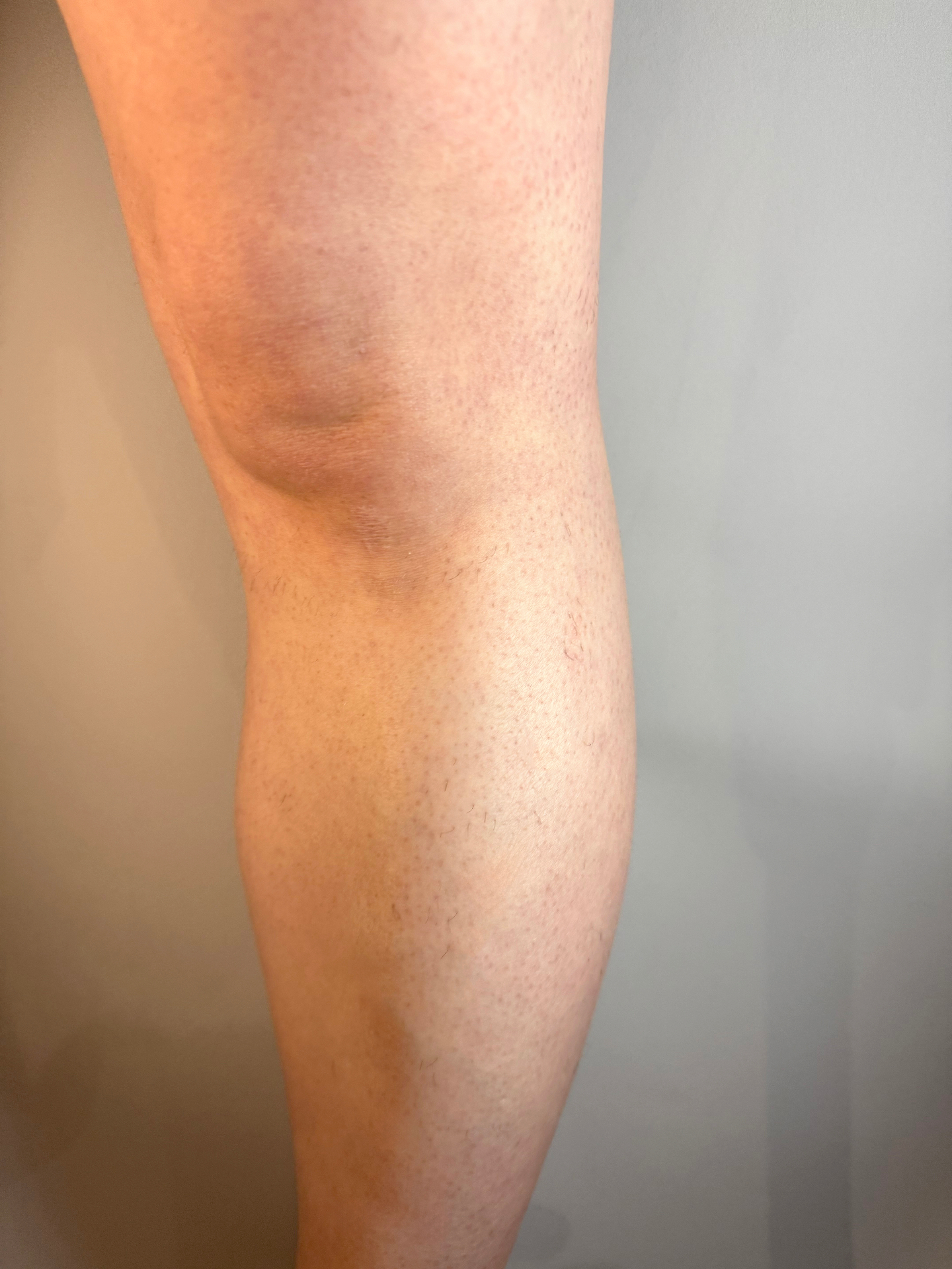 Leg hair reduction after 4 laser sessions